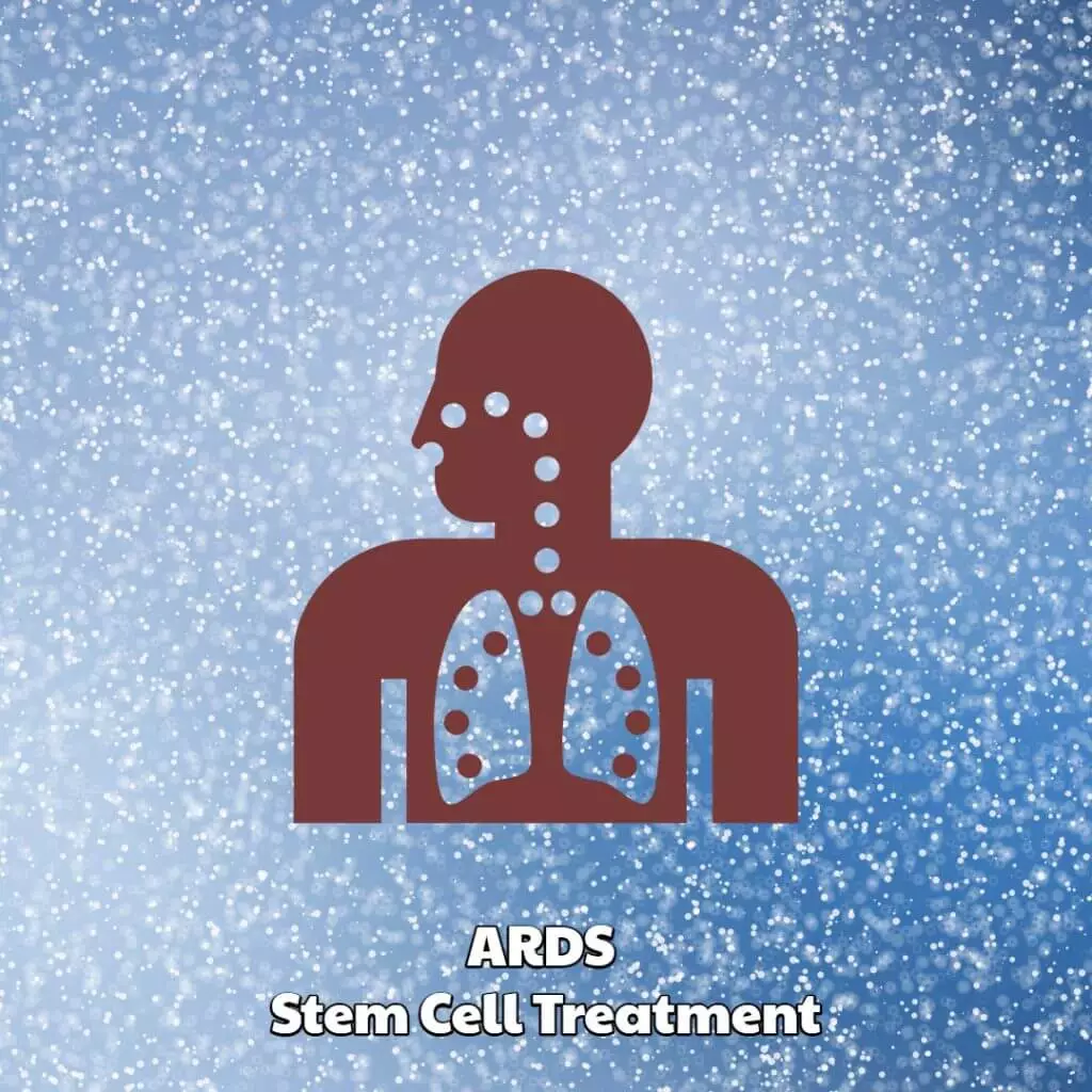 ARDS Stem Cell Treatment