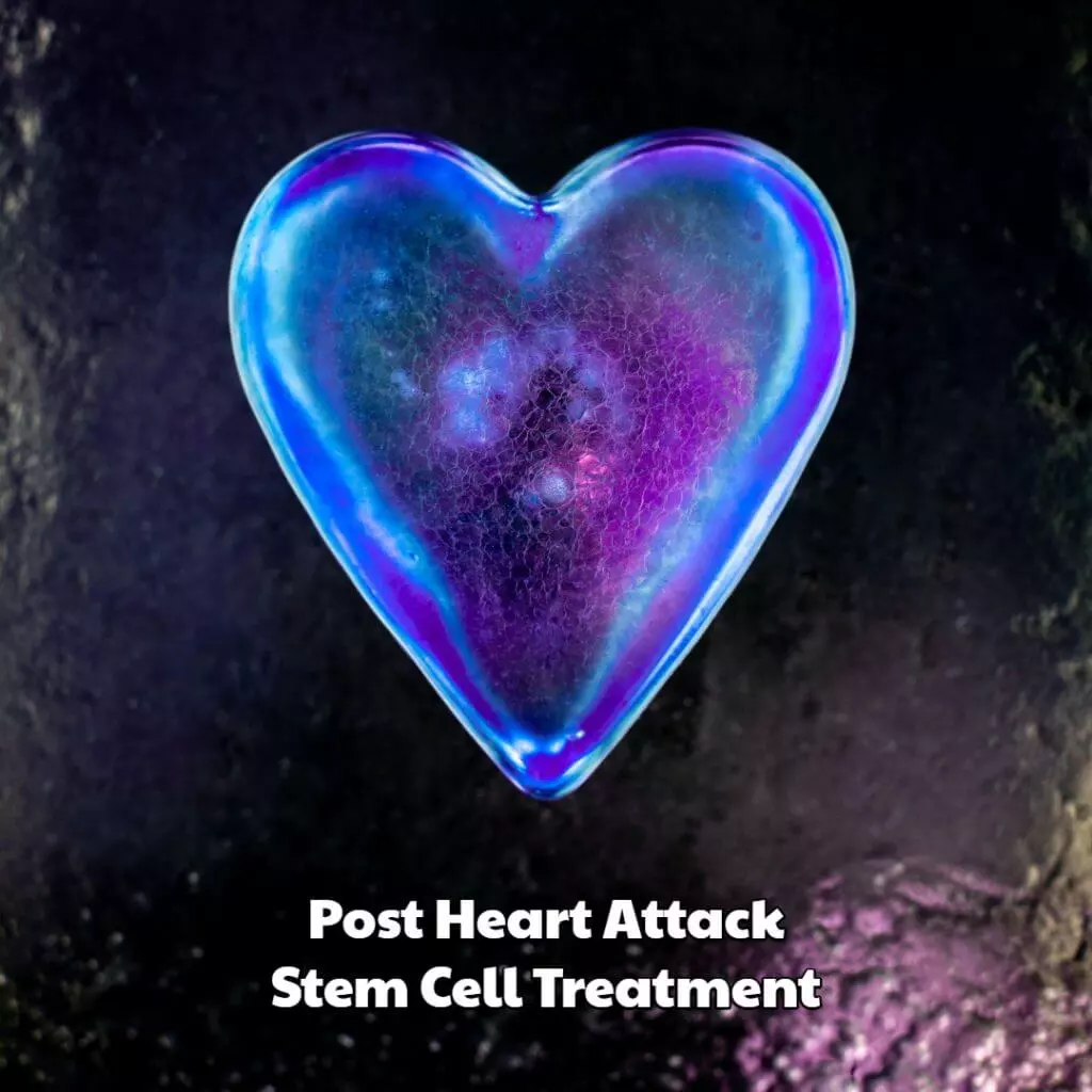 Post Heart Attack stem cell treatment for Fast Recovery
