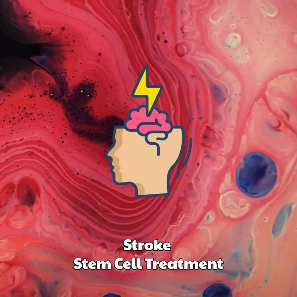 Stroke Stem Cell Therapy